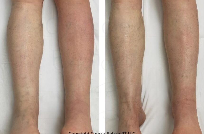Before and after of lymphatic drainage massage.
