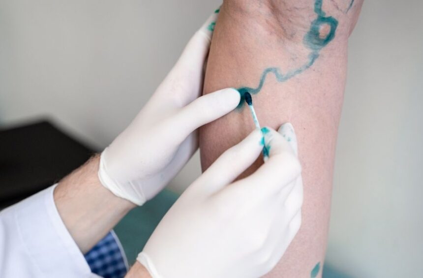 Lymphedema surgery.