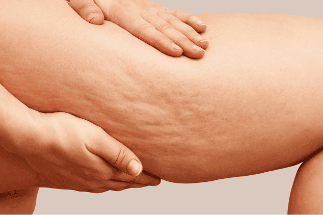 Visual of cellulite. 
