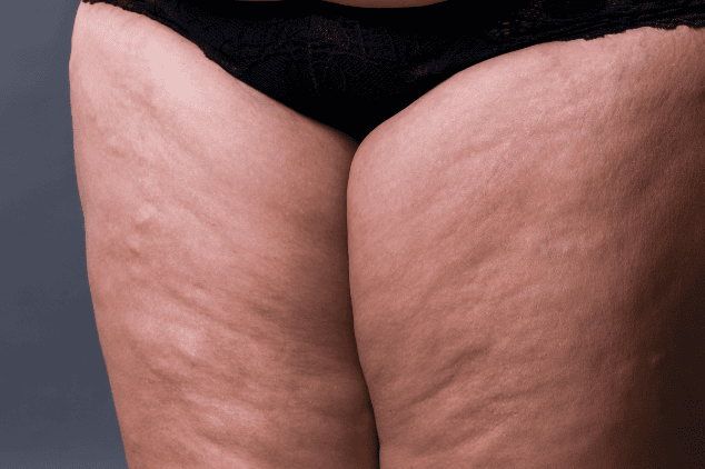Visual of lipedema.