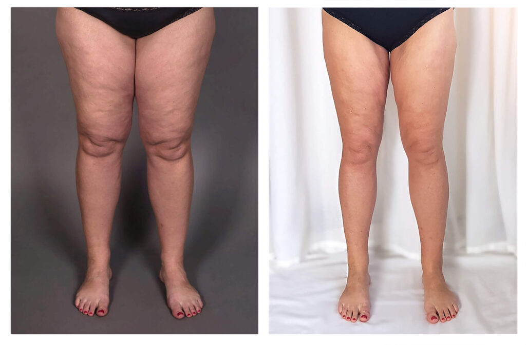 lipedema vs cellulite 