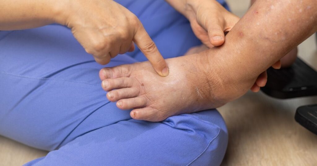 Physical therapist looking at a leg/foot with lymphedema. Lymphedema diet can help.