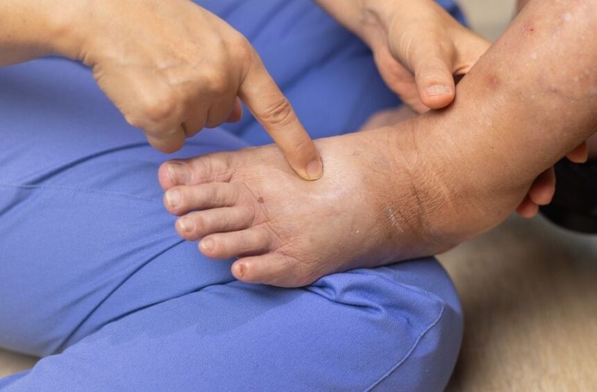 Physical therapist looking at a leg/foot with lymphedema. Lymphedema diet can help.