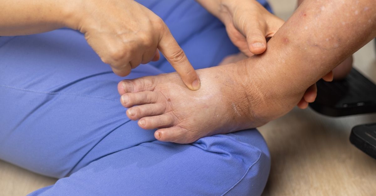 Physical therapist looking at a leg/foot with lymphedema. Lymphedema diet can help.
