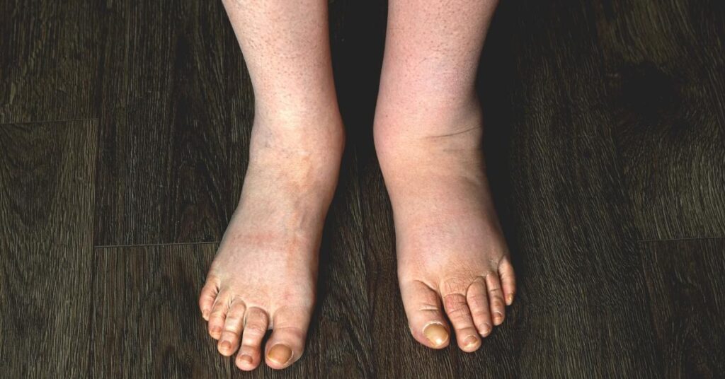 lower legs and feet with left foot showing swelling in one foot only