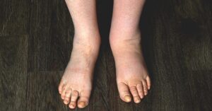 Swelling in One Foot Only: Possible Causes, What to Do