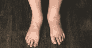 Swelling in One Foot Only: Possible Causes, What to Do