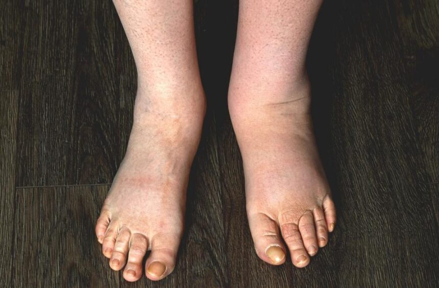 lower legs and feet with left foot showing swelling in one foot only