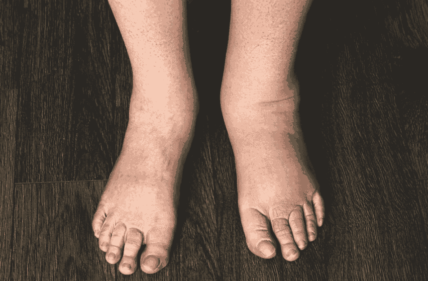 Swelling in one foot only.