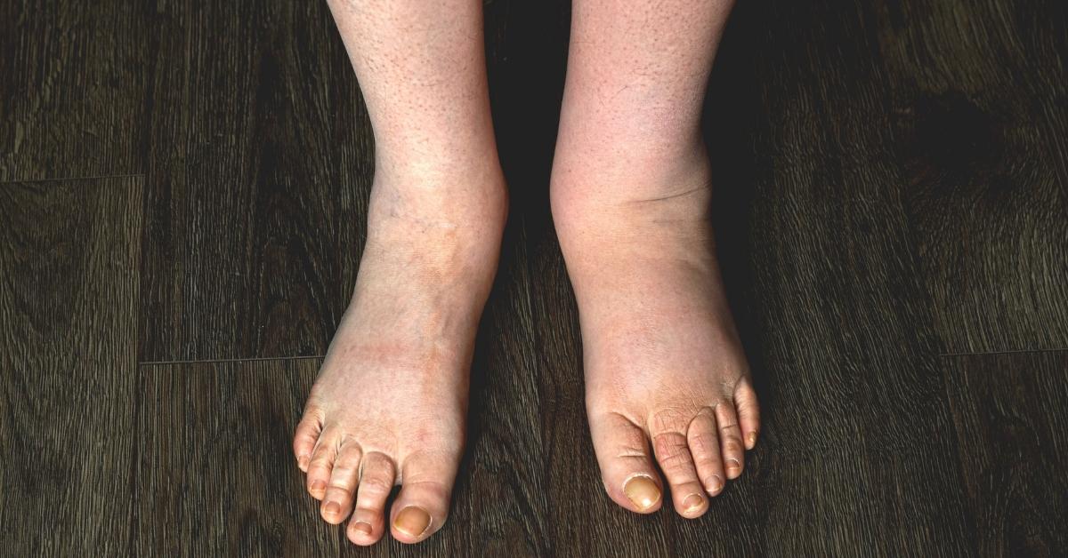 lower legs and feet with left foot showing swelling in one foot only