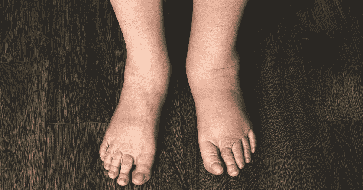 Swelling in one foot only.