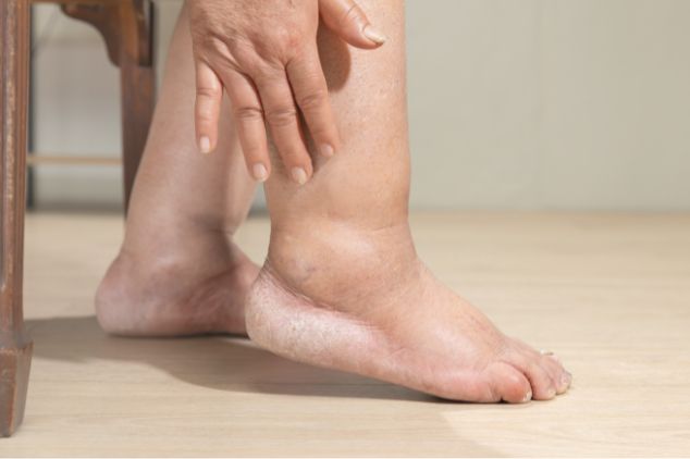 Swelling in one foot only due to lymphedema. 