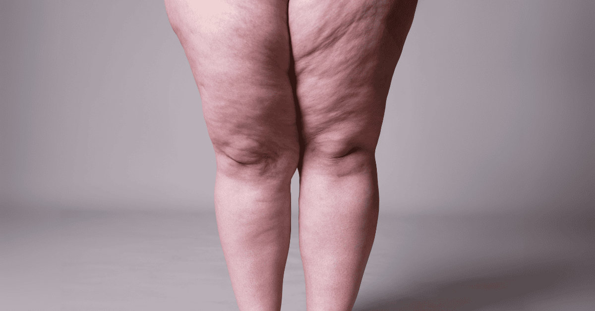 Legs with lipedema.