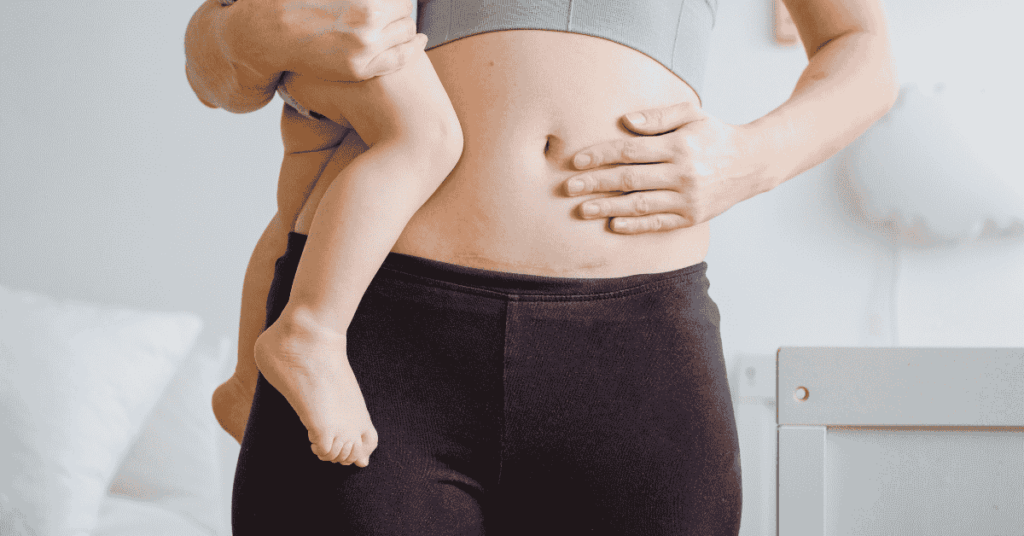 Mom with postpartum swelling.
