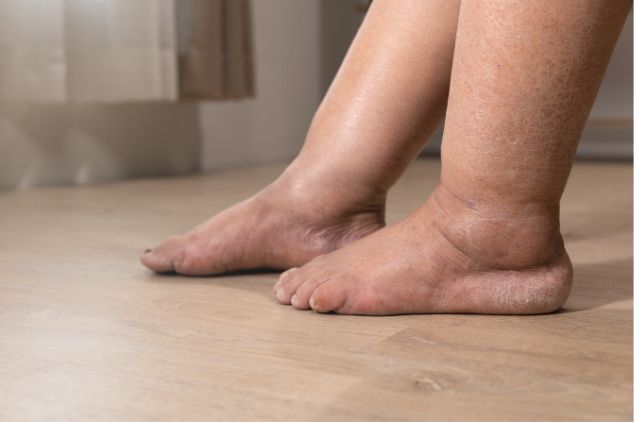 Image of swelling in one foot only.