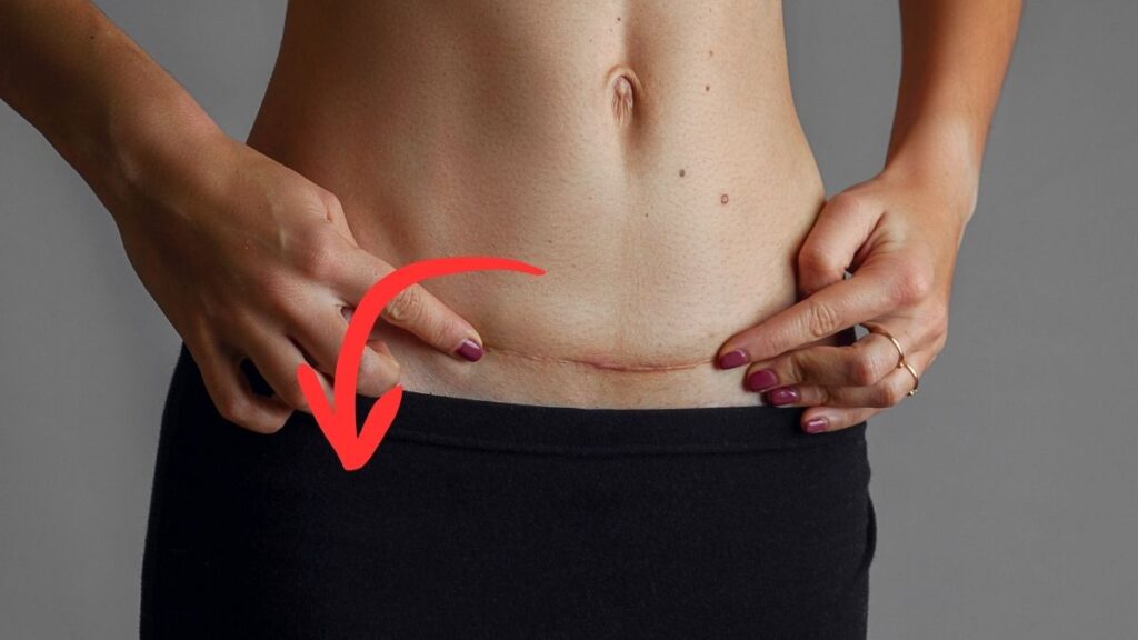 Photo of woman's stomach that shows swelling after a C-section.