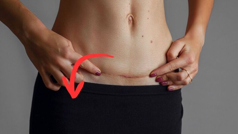 How To Reduce Stomach Swelling After C Section | TAFT Independent