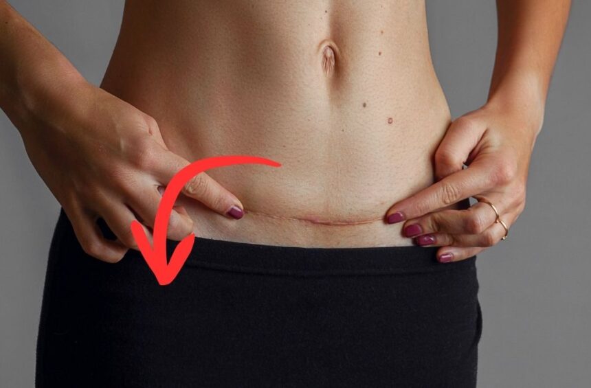 Photo of woman's stomach that shows swelling after a C-section.