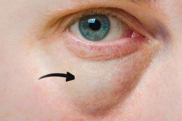 Puffiness around your eyes as a sign of poor lymphatic drainage face.