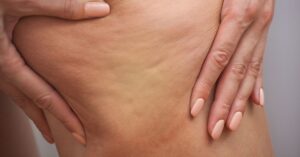 Fibrosis in Lymphedema: What It Is and How to Manage It