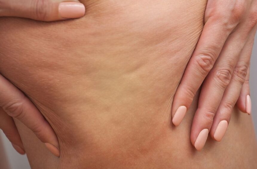 A person showing the fibrosis in their leg.