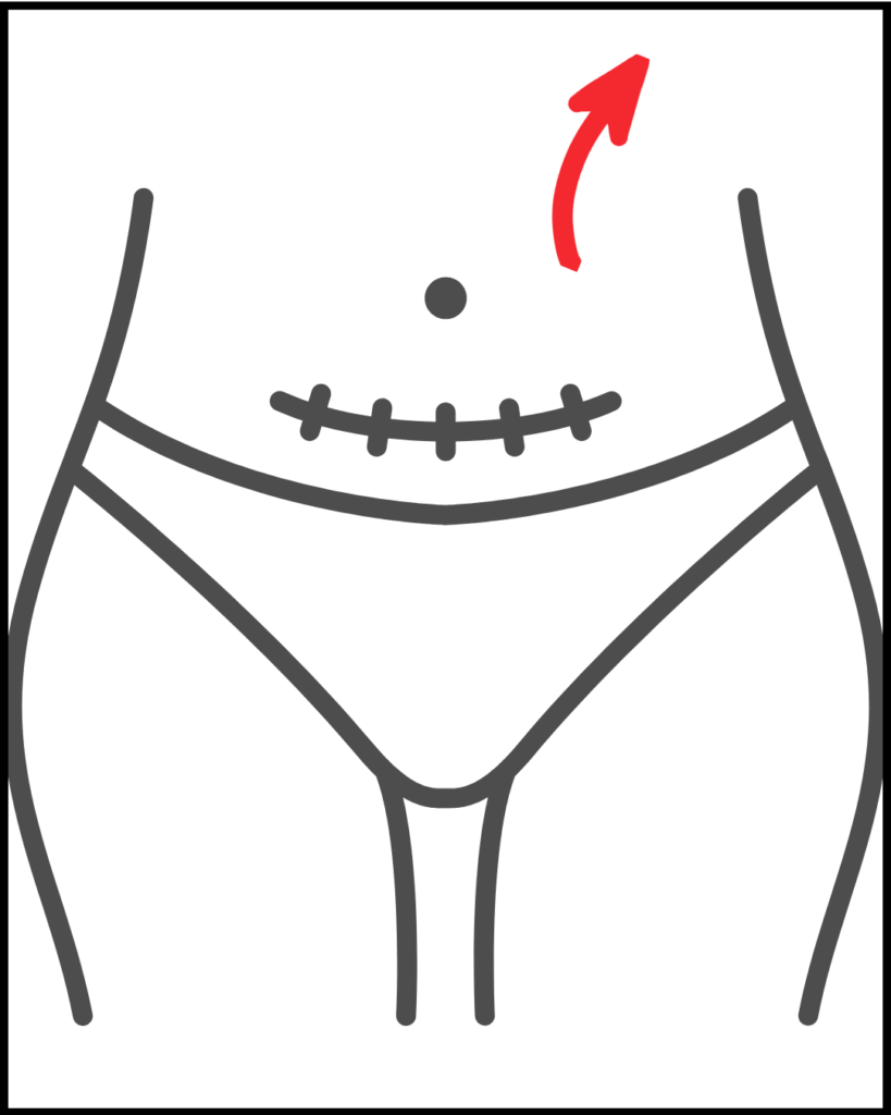 Lymphatic drainage massage for swelling after C-section, step 4. Massaging upper left area.