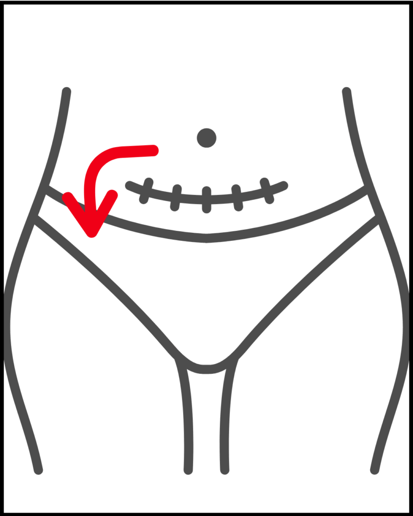 Lymphatic drainage massage for swelling after C-section, step 5. Massaging lower right area.