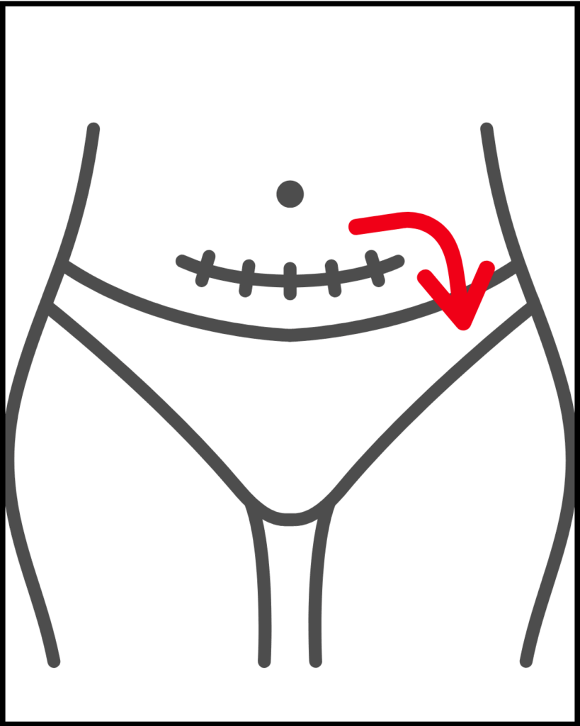 Lymphatic drainage massage for swelling after C-section, step 6. Massaging lower left area.