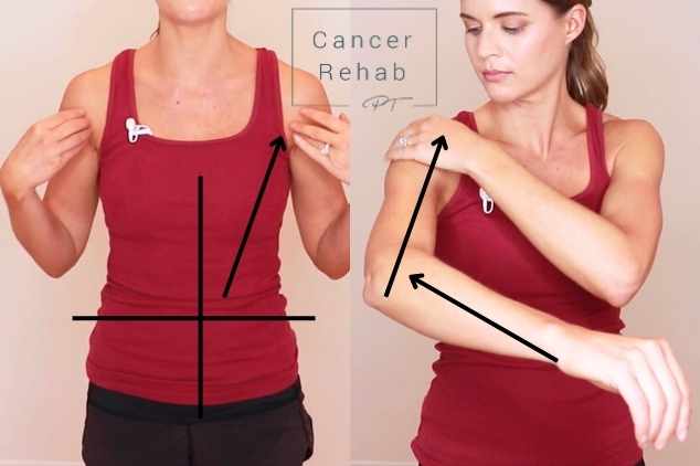 A certified lymphedema therapist demonstrating lymphatic drainage massage to the trunk and arms.