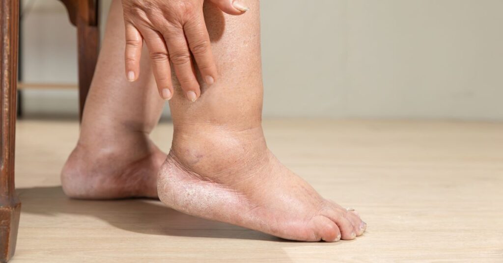 Visual of lymphedema. What does lymphedema pain feel like?