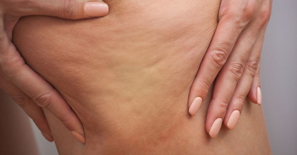 Fibrosis in lymphedema