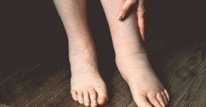 How to Reduce Swelling in Legs and Feet