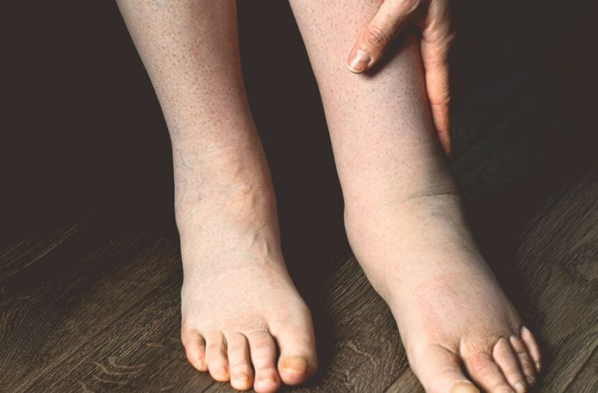 Close-up of a person holding their swollen leg and ankle to show swelling in legs and feet.