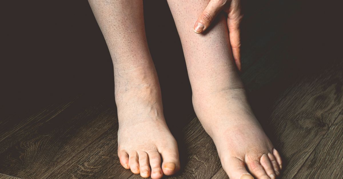 Close-up of a person holding their swollen leg and ankle to show swelling in legs and feet.