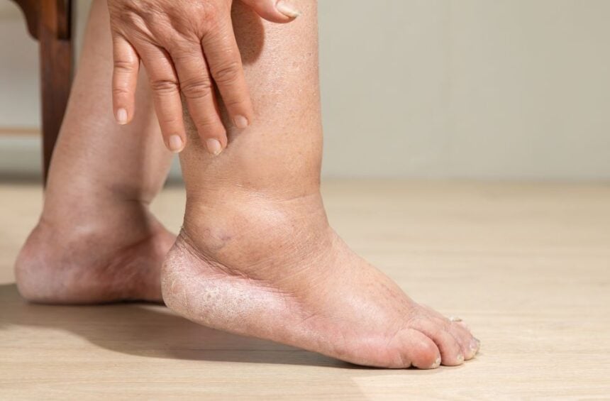Ankle lymphedema