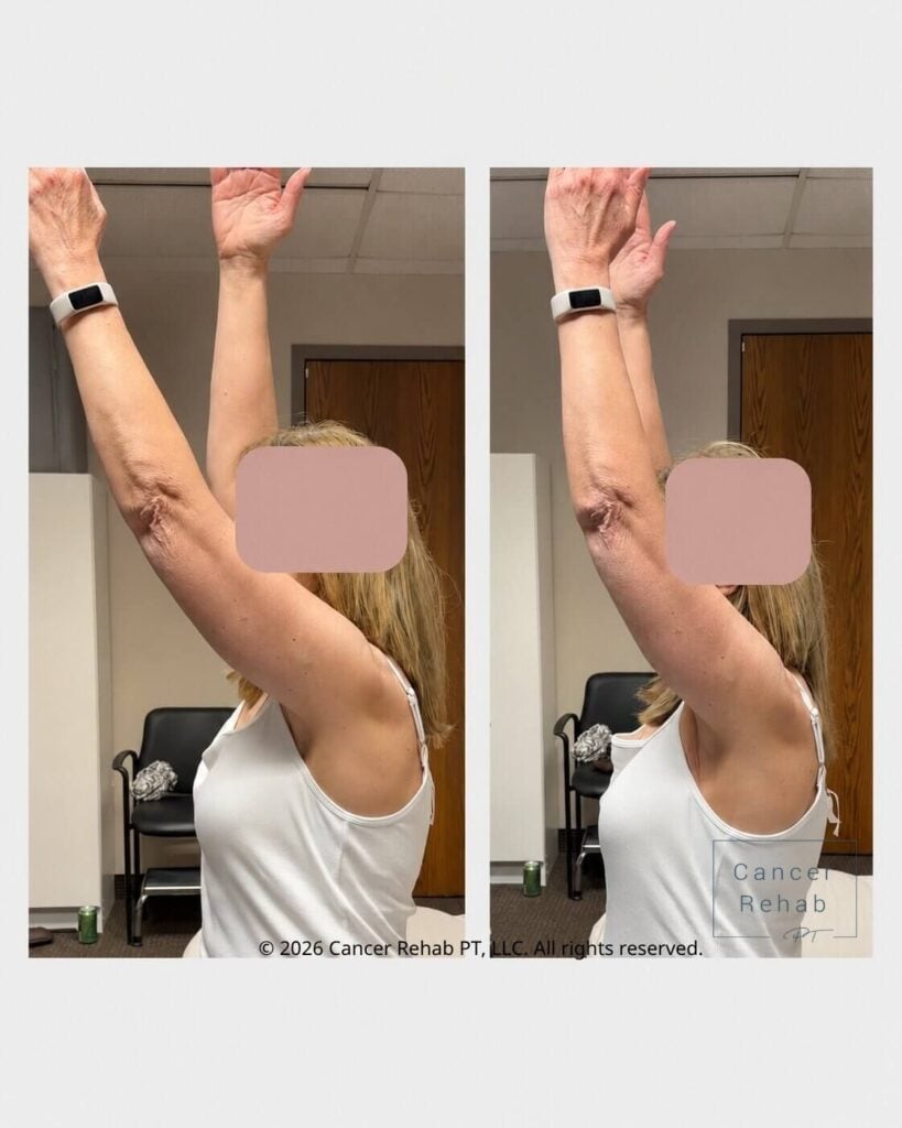 Woman with radiation fibrosis for breast cancer, side view, before and after physical therapy.