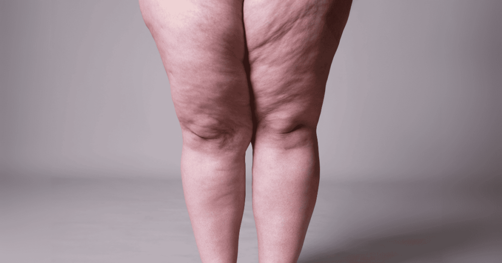 Two legs with lipedema.