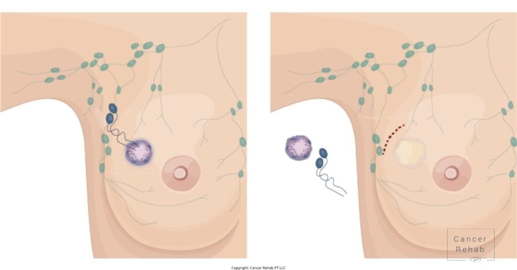 Side Effects of Lymph Node Removal in Armpit and What to Do