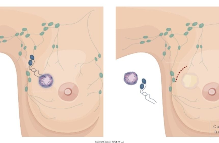 Side Effects of Lymph Node Removal in Armpit Featured.