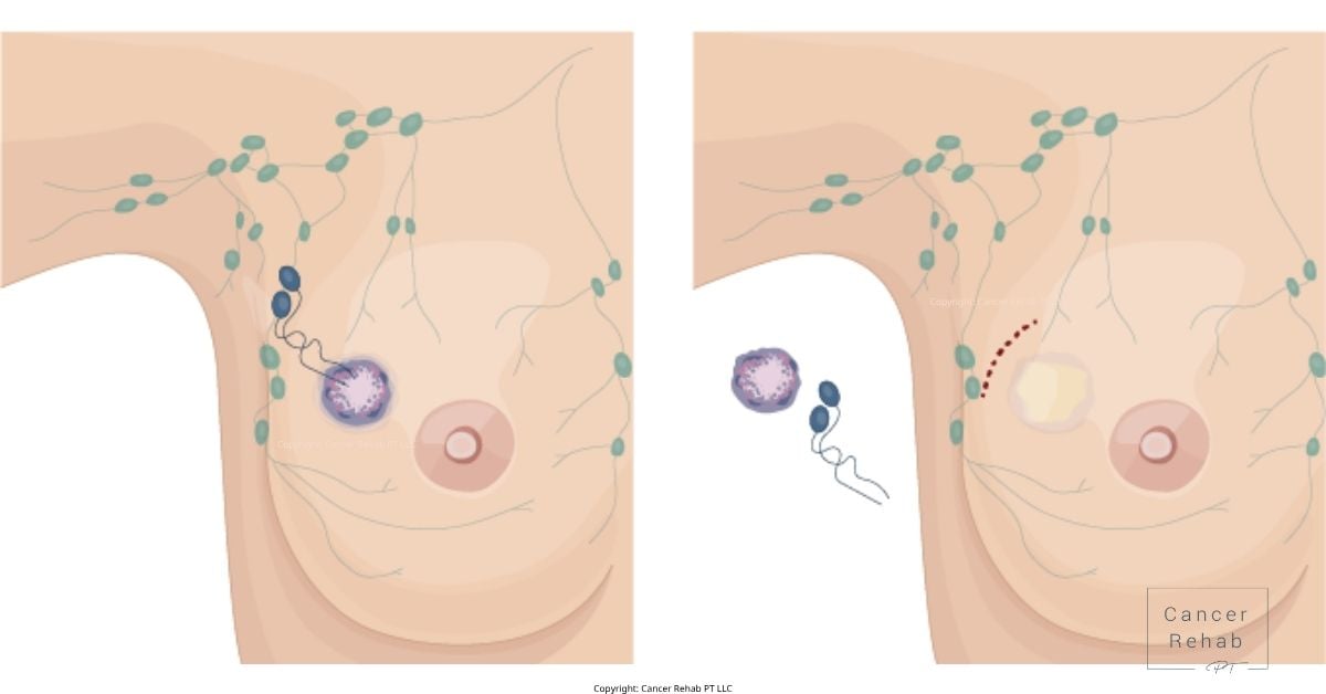 Side Effects of Lymph Node Removal in Armpit Featured.